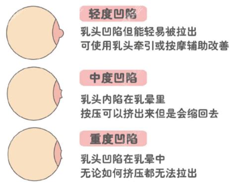 奶頭毛|乳頭內凹、長毛正常嗎？ 8類「乳頭形狀」你的是哪種 